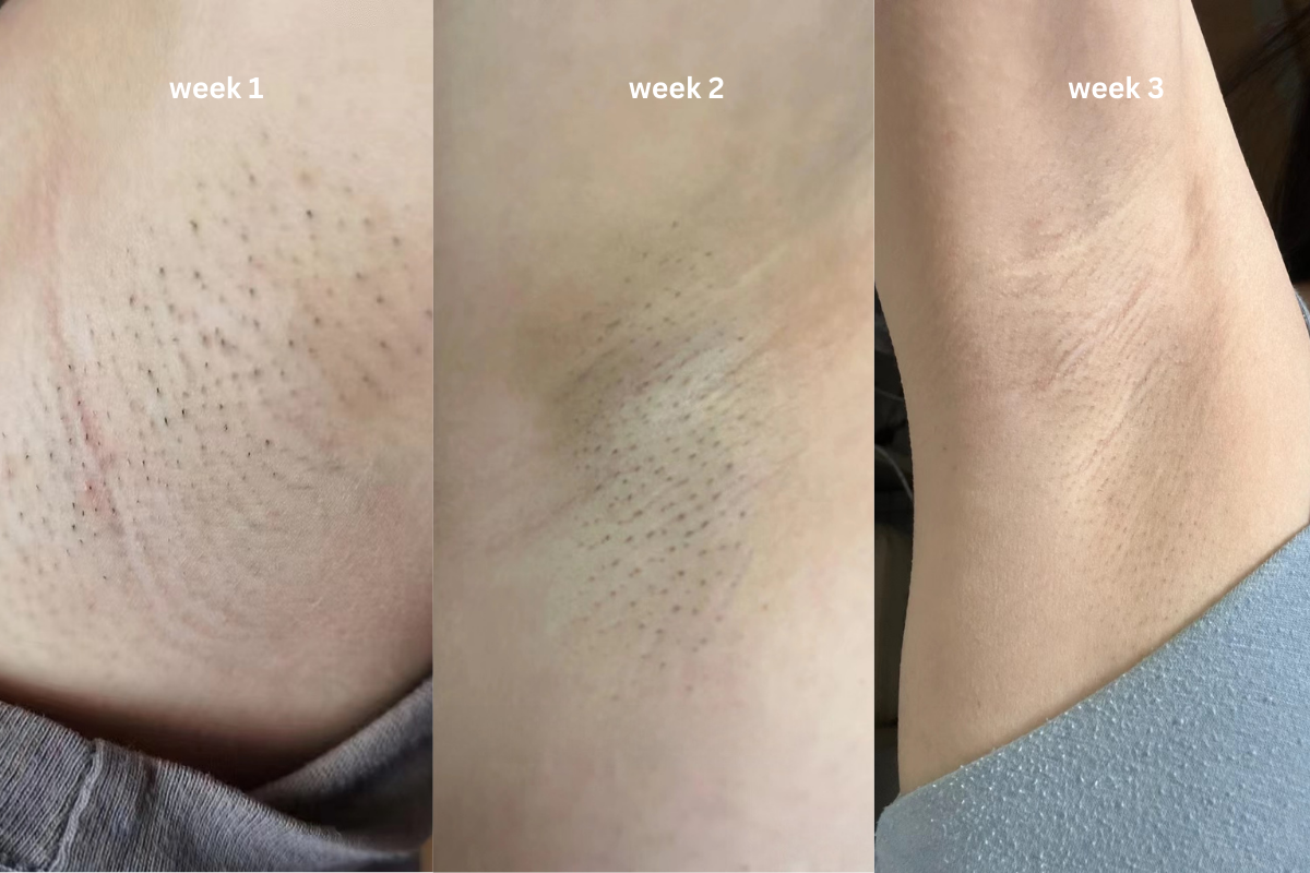 The ad said results in 4 weeks, so I thought, why not try since there’s a 90-day guarantee. But to my surprise, I started seeing noticeable results by the third week!