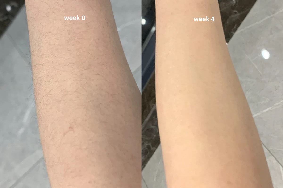 Completely painless! I used to get laser hair removal at salons, but it was so painful,and left my skin red, but Vavame is totally pain-free, even for the bikini area. After 4 weeks, Barely any hair growth.