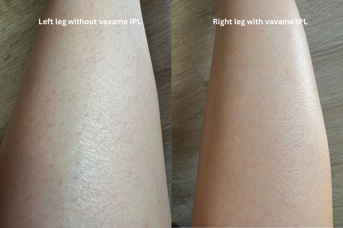 I tested this product on my legs: no Vavame IPL on my left leg, and IPL on my right. After two weeks of use, I stopped. A week later, hair grew back on the left leg, but not on the right! Highly recommend!